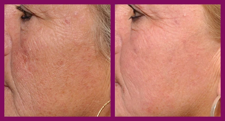 Морщины и фотоповрежденная кожа лица, пигментные пятна. Фото до и после 1 процедуры омоложения HALO.