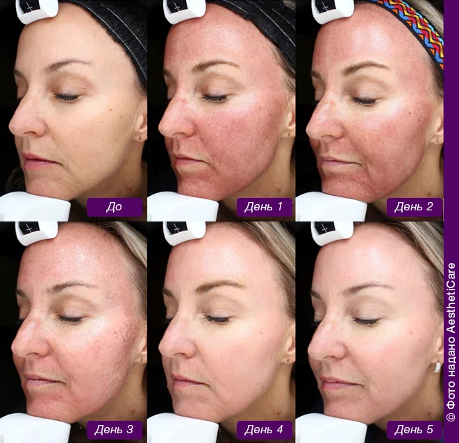 Фото, відновлення шкіри після лазерного шліфування HALO 30% по днях