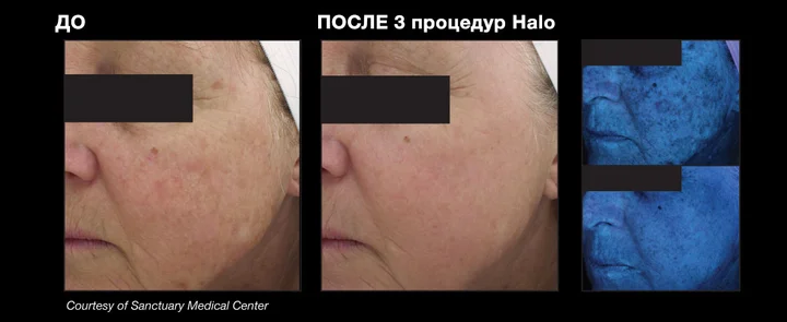 Фото до і після 3 процедур HALO