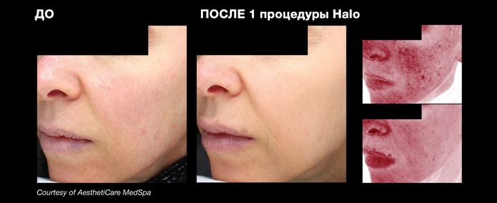 Фото до и после 3 процедур лазерного омоложения HALO