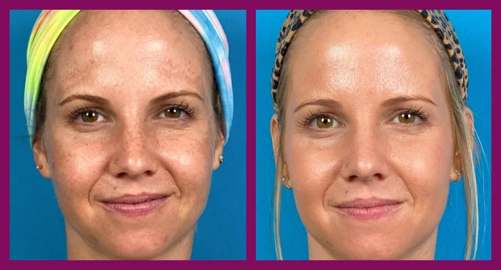 Солнечное лентиго на лице, фото до и после 1 шлифовки HALO.