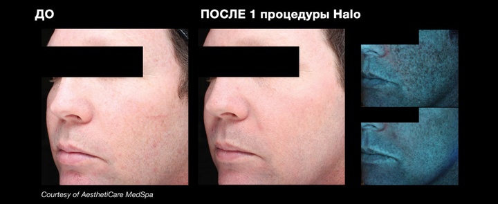 До и после 1 процедуры лазерного омоложения HALO
